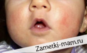 Опыт лечения атопического дерматита у детей